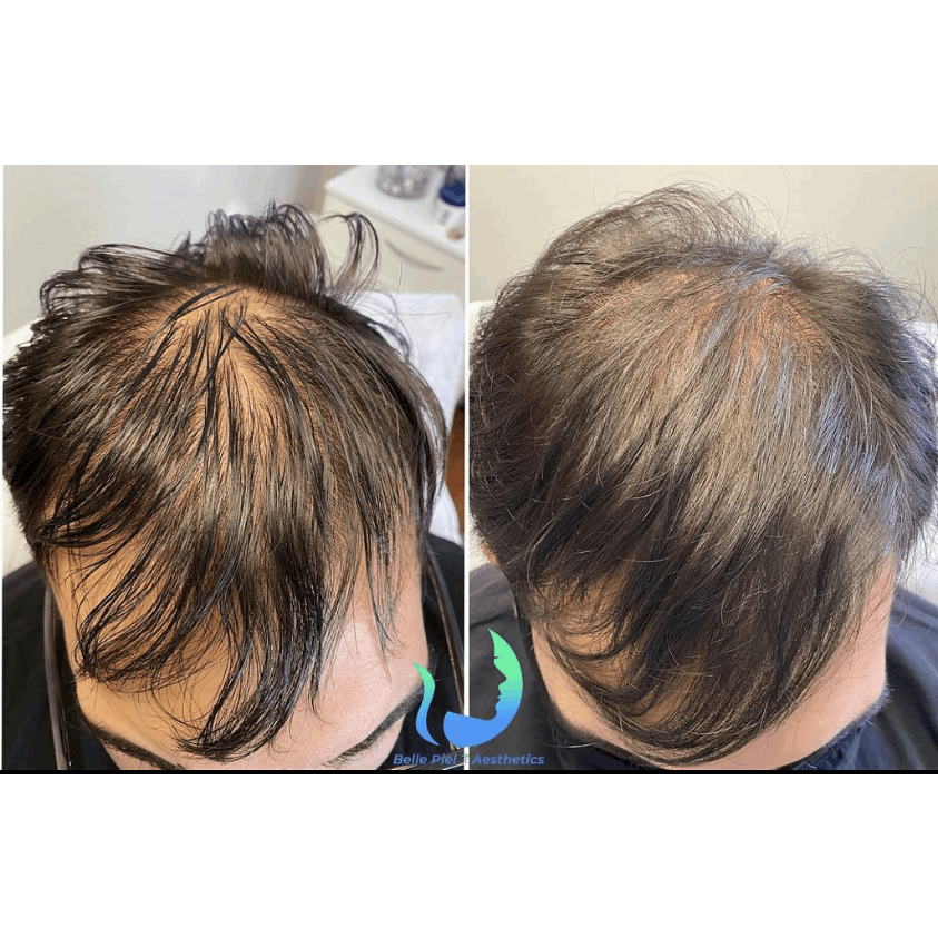 Hair Restoration After PRP Treatment in Farmingville, NY | Belle Piel Aesthetics