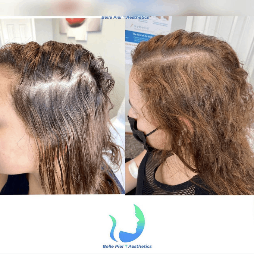 Hair Restoration After PRP Treatment in Farmingville, NY | Belle Piel Aesthetics