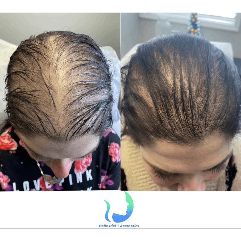 Hair Restoration After PRP Treatment in Farmingville, NY | Belle Piel Aesthetics