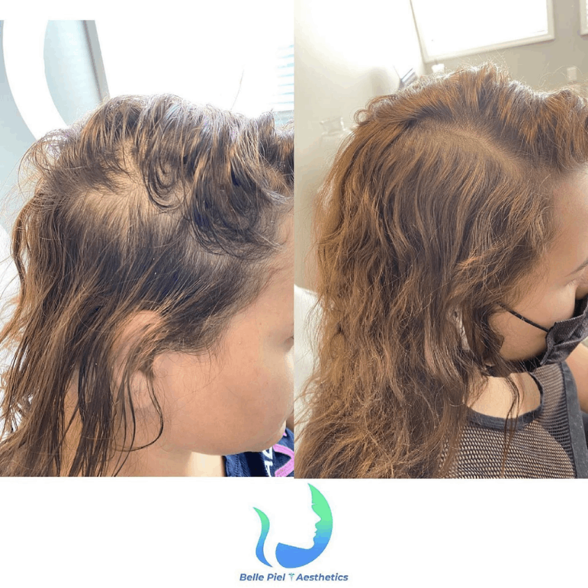 Hair Restoration After PRP Treatment in Farmingville, NY | Belle Piel Aesthetics