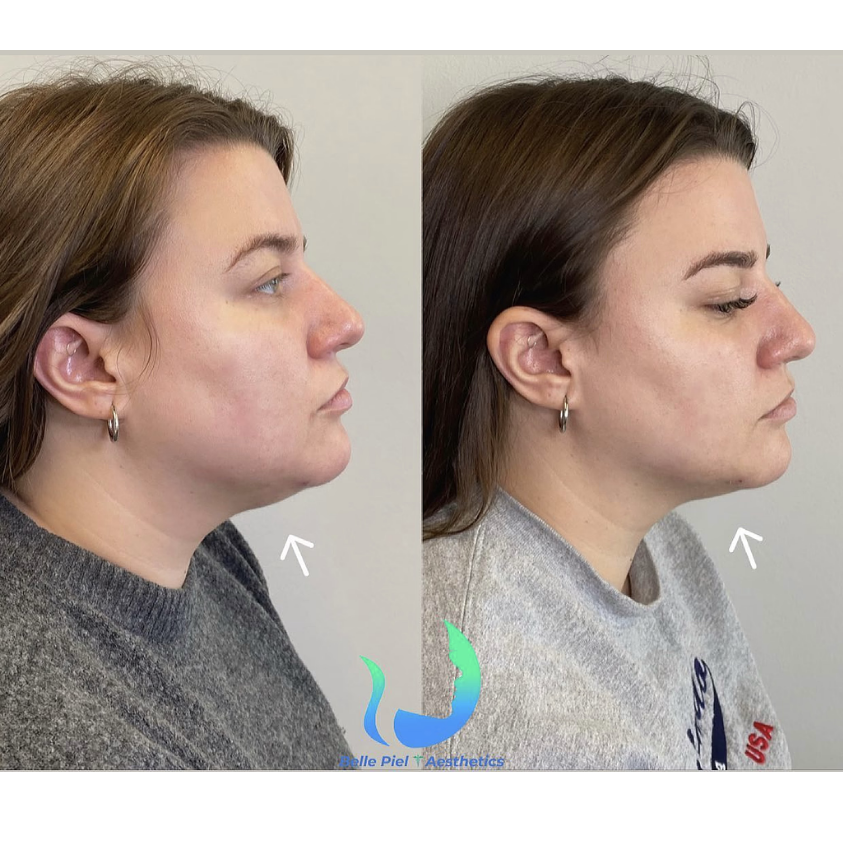 Kybella Treatment | Belle Piel Aesthetics | Farmingville, NY