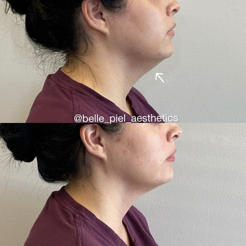 Kybella Treatment | Belle Piel Aesthetics | Farmingville, NY