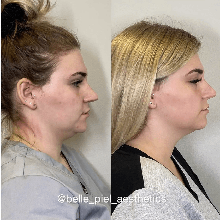 Kybella Treatment | Belle Piel Aesthetics | Farmingville, NY