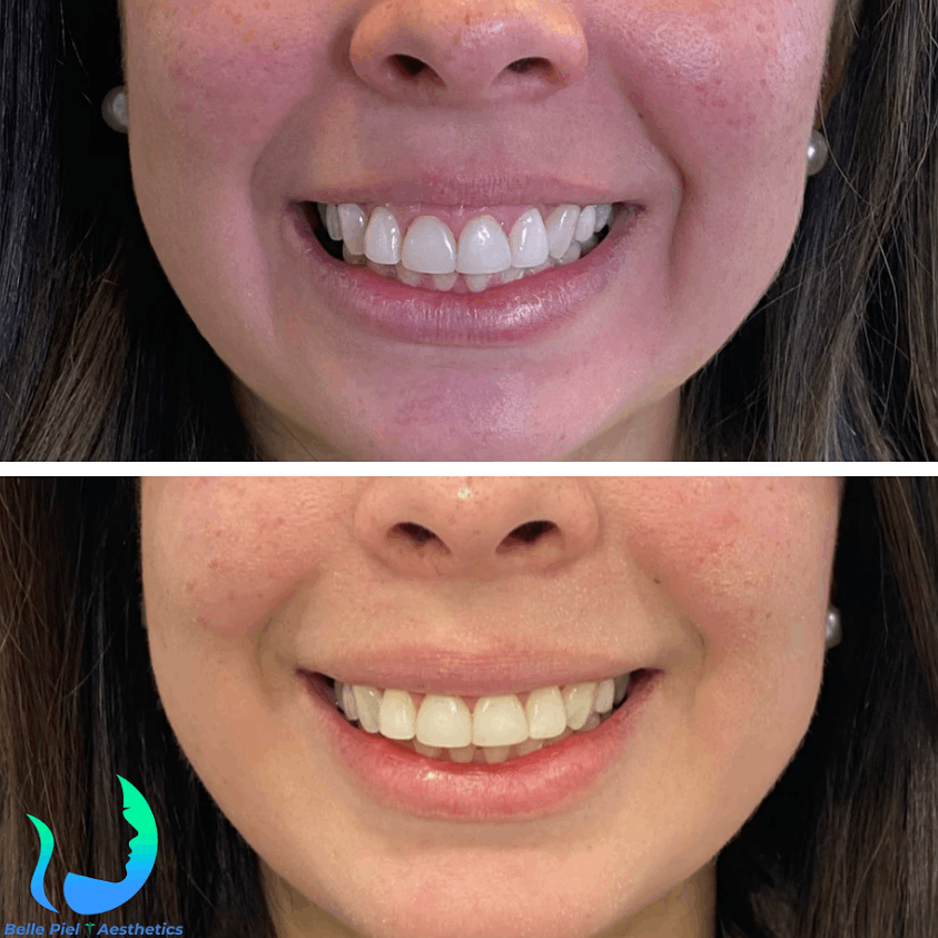 Lip Flip and Gummy Smile Correction Treatment | Belle Piel Aesthetics | Farmingville, NY