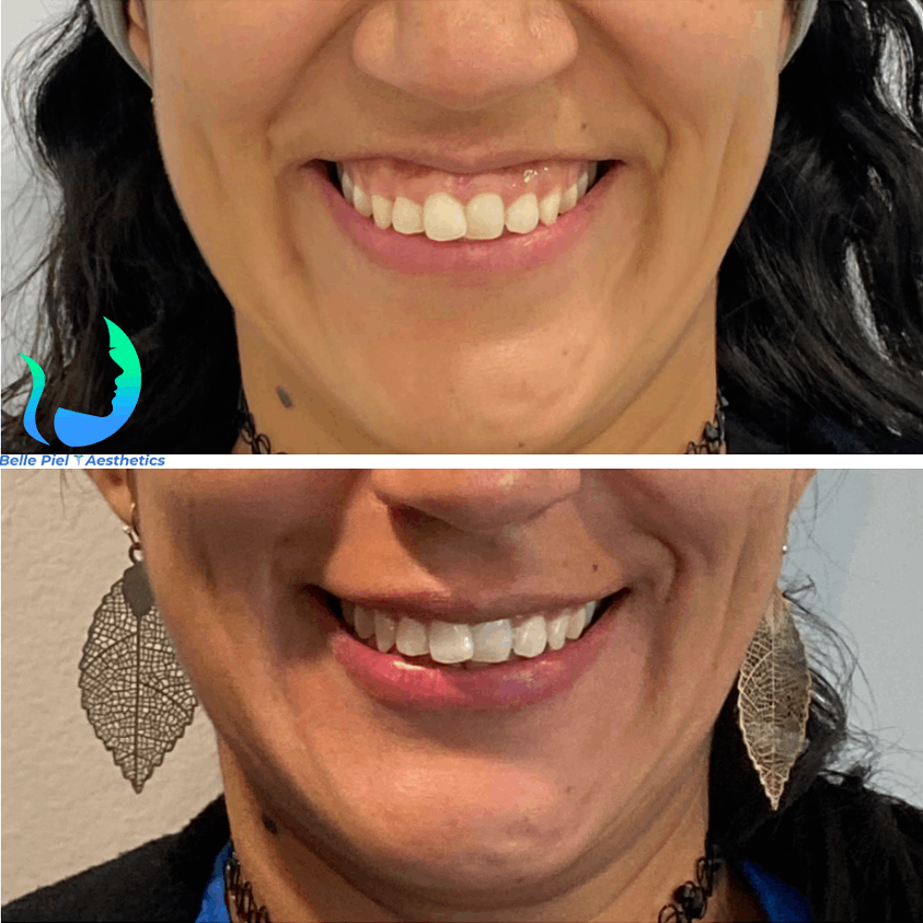 Lip Flip and Gummy Smile Correction Treatment | Belle Piel Aesthetics | Farmingville, NY