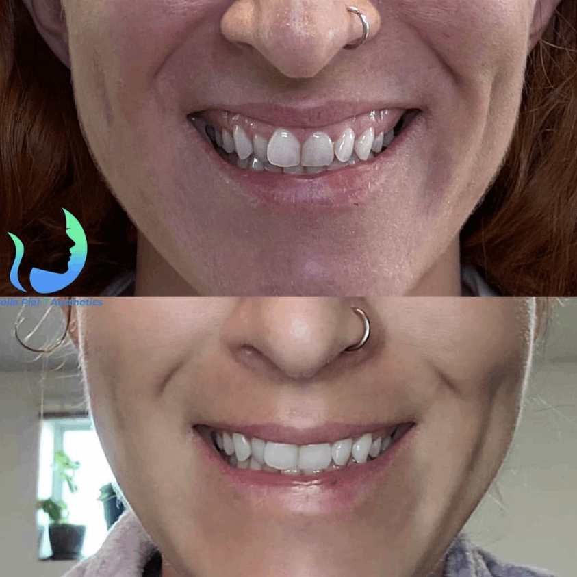 Lip Flip and Gummy Smile Correction Treatment | Belle Piel Aesthetics | Farmingville, NY