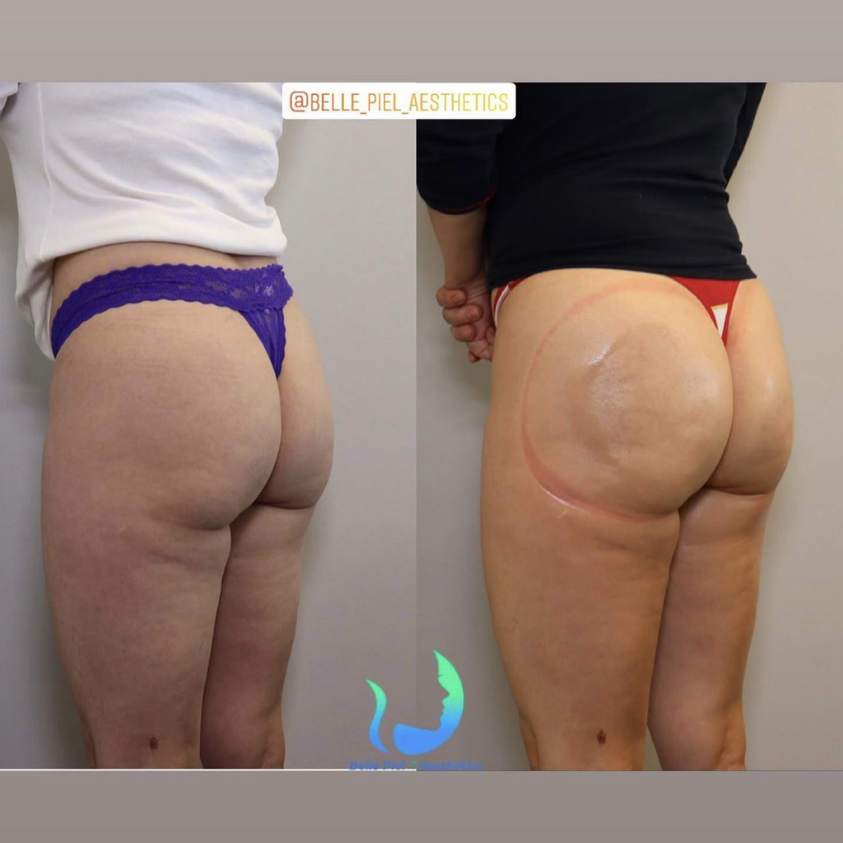 Vacuum Therapy ButtCupping Treatment | Belle Piel Aesthetics | Farmingville, NY