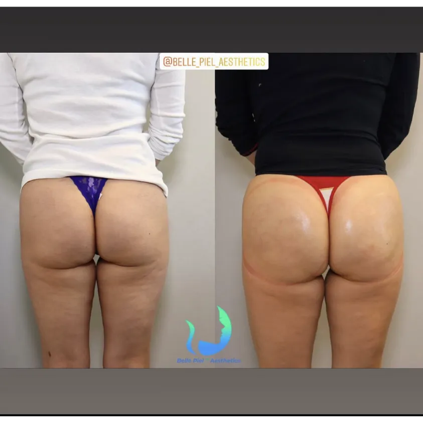 Vacuum Therapy ButtCupping Treatment | Belle Piel Aesthetics | Farmingville, NY