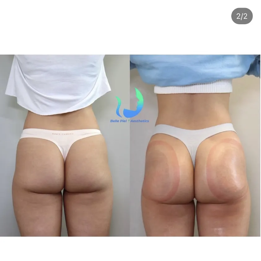 Vacuum Therapy ButtCupping Treatment | Belle Piel Aesthetics | Farmingville, NY
