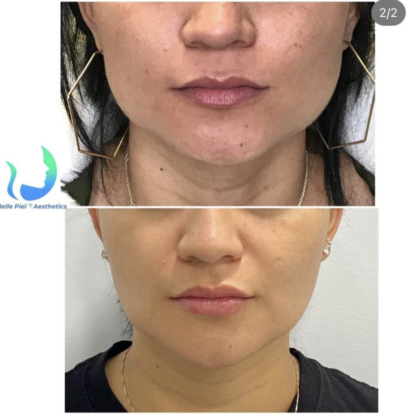 Masseter Tox or Face Slimming Treatment in Farmingville, NY | Belle Piel Aesthetics