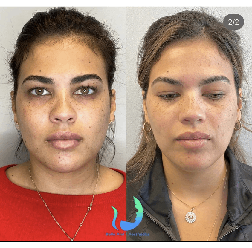 Masseter Tox or Face Slimming Treatment | Belle Piel Aesthetics | Farmingville, NY