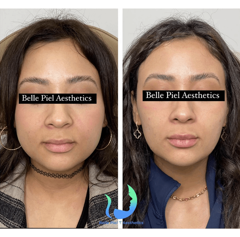 Masseter Tox or Face Slimming Treatment | Belle Piel Aesthetics | Farmingville, NY