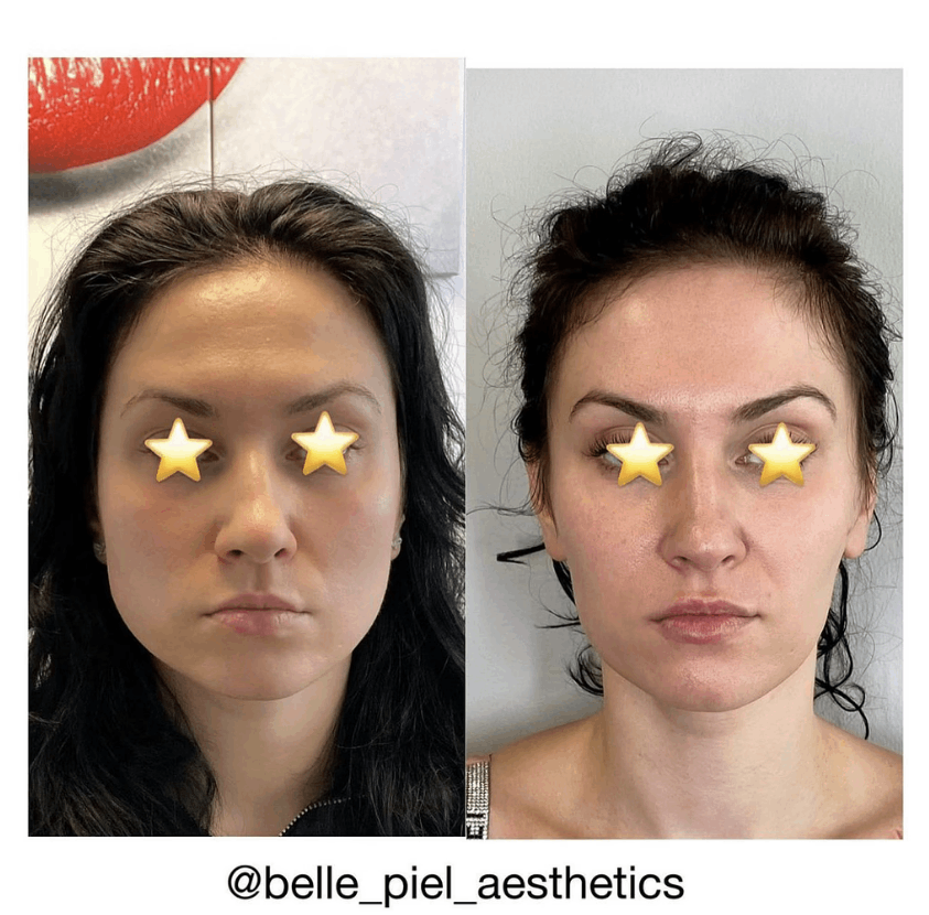 Masseter Tox or Face Slimming Treatment | Belle Piel Aesthetics | Farmingville, NY