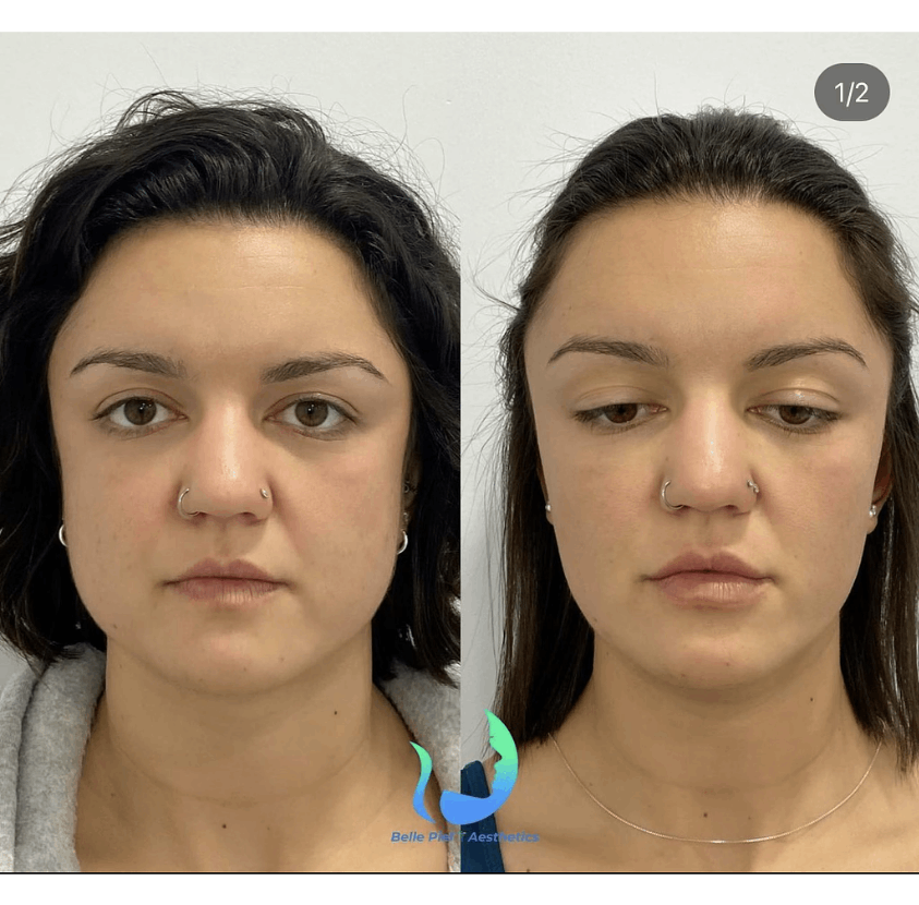 Masseter Tox or Face Slimming Treatment | Belle Piel Aesthetics | Farmingville, NY