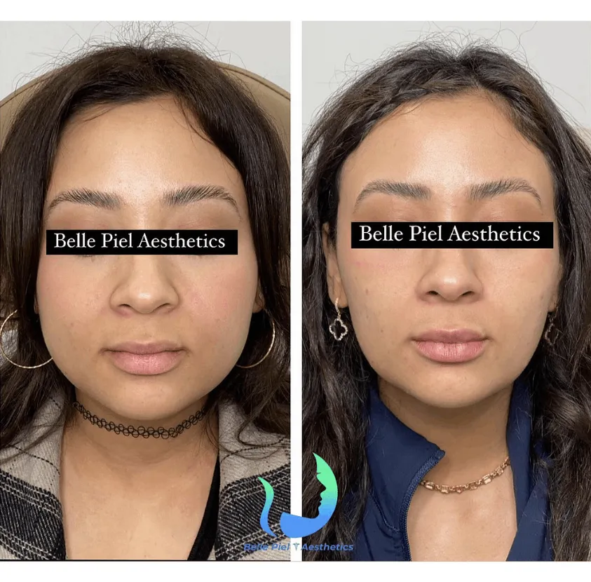 Masseter Tox or Face Slimming Treatment | Belle Piel Aesthetics | Farmingville, NY