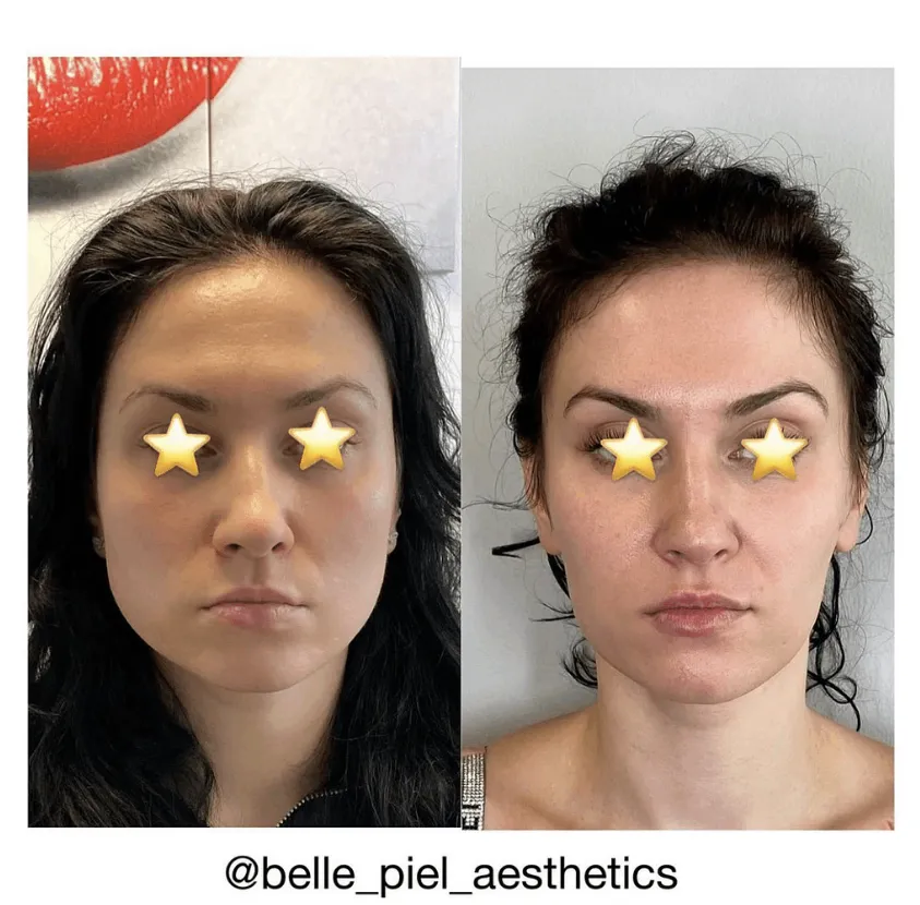 Masseter Tox or Face Slimming Treatment | Belle Piel Aesthetics | Farmingville, NY