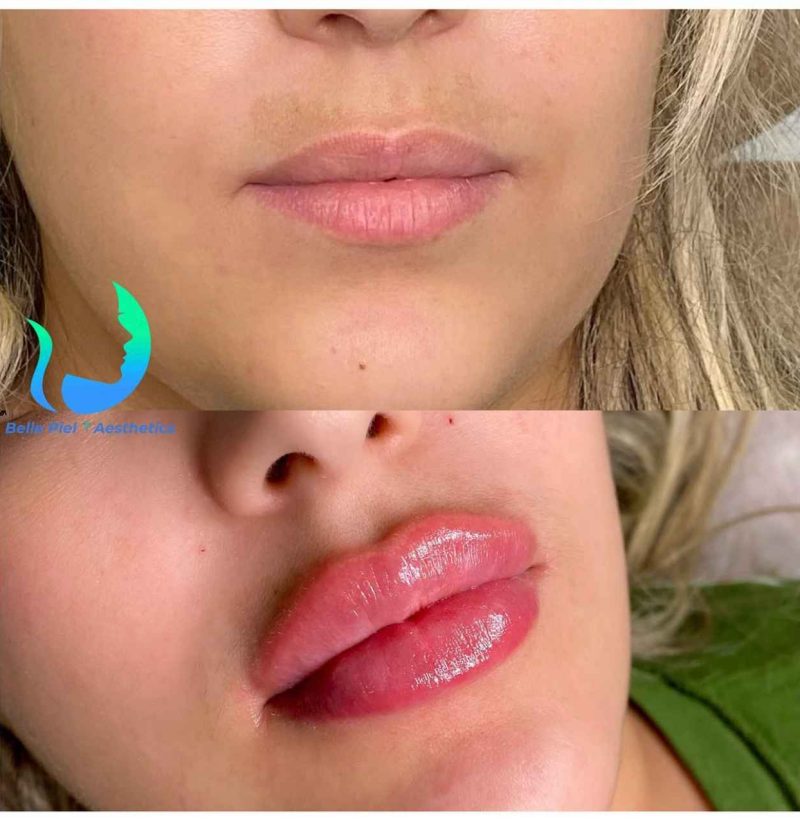 Lip Enhancement Before After Treatment | Belle Piel Aesthetics | Farmingville, NY