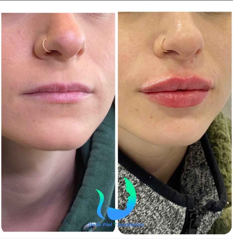 Lip Enhancement Before After Treatment | Belle Piel Aesthetics | Farmingville, NY