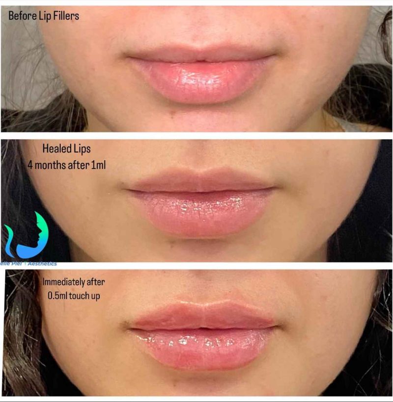 Lip Enhancement Before After Treatment | Belle Piel Aesthetics | Farmingville, NY