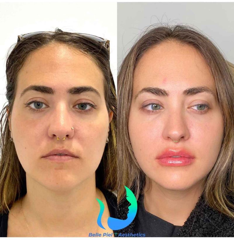 Lip Enhancement Before After Treatment | Belle Piel Aesthetics | Farmingville, NY