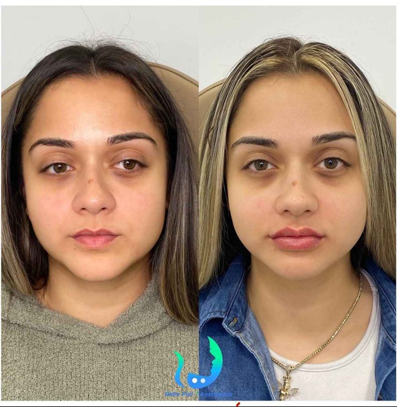 Lip Enhancement Before After Treatment | Belle Piel Aesthetics | Farmingville, NY