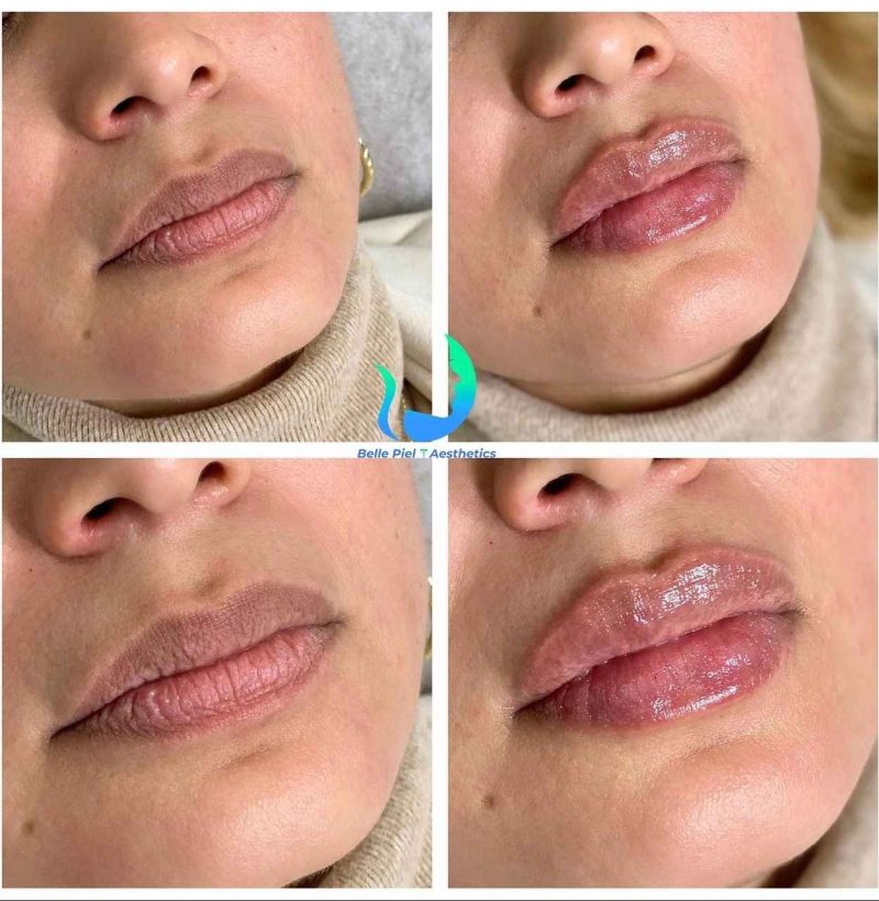 Lip Enhancement Before After Treatment | Belle Piel Aesthetics | Farmingville, NY