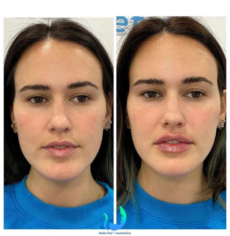 Lip Enhancement Before After Treatment | Belle Piel Aesthetics | Farmingville, NY