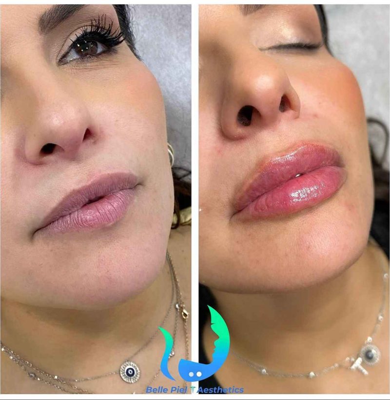 Lip Enhancement Before After Treatment | Belle Piel Aesthetics | Farmingville, NY