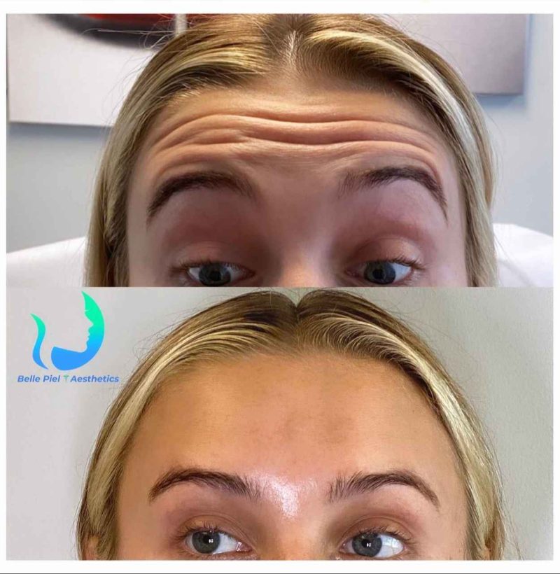 Neurotoxin Before After Treatment | Belle Piel Aesthetics | Farmingville, NY