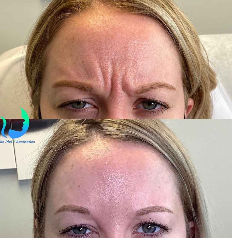 Neurotoxin Before After Treatment | Belle Piel Aesthetics | Farmingville, NY