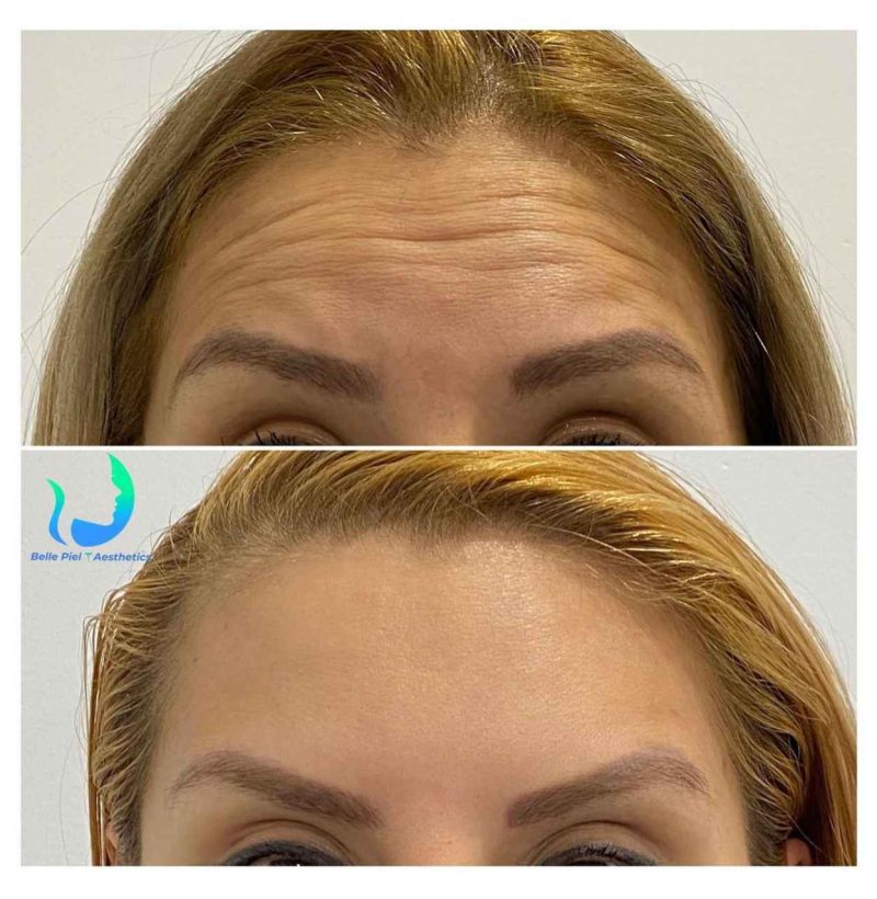 Neurotoxin Before After Treatment | Belle Piel Aesthetics | Farmingville, NY