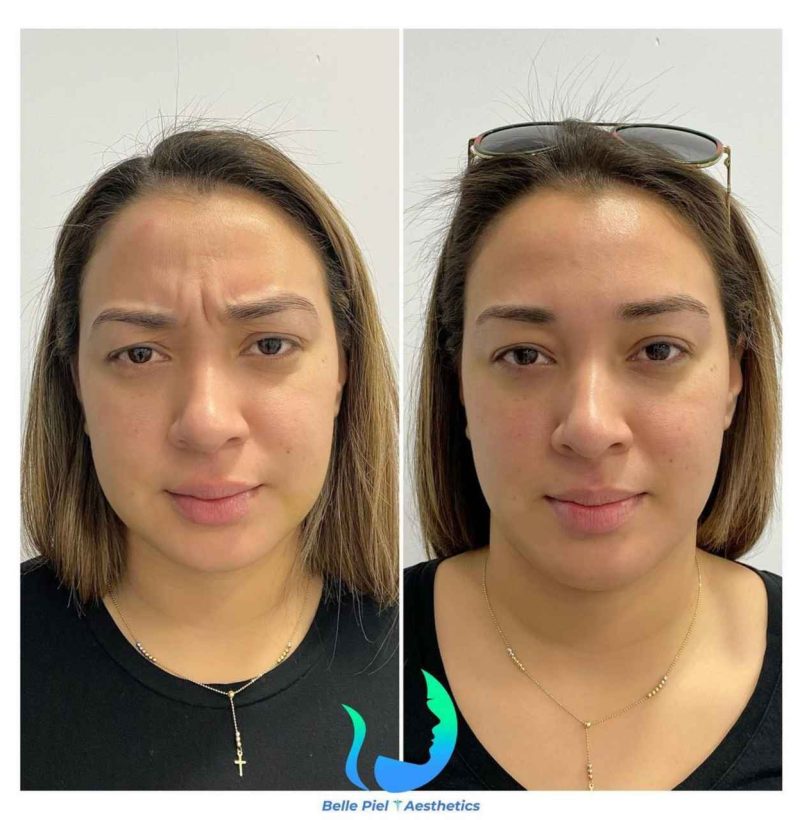 Neurotoxin Before After Treatment | Belle Piel Aesthetics | Farmingville, NY