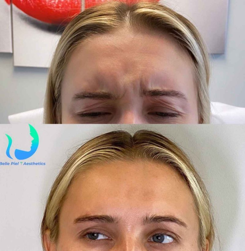 Neurotoxin Before After Treatment | Belle Piel Aesthetics | Farmingville, NY