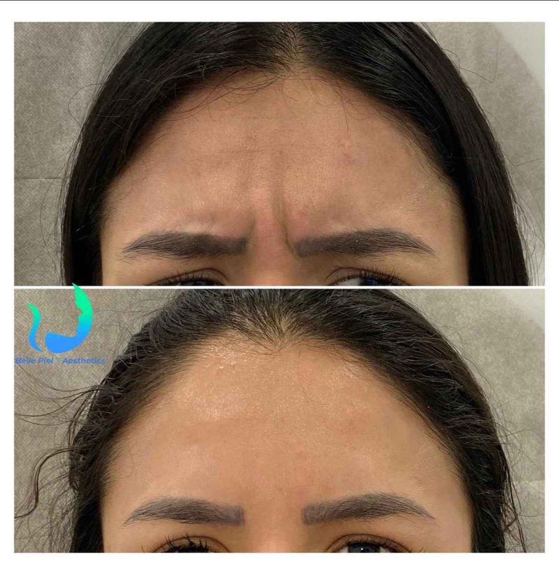 Neurotoxin Before After Treatment | Belle Piel Aesthetics | Farmingville, NY