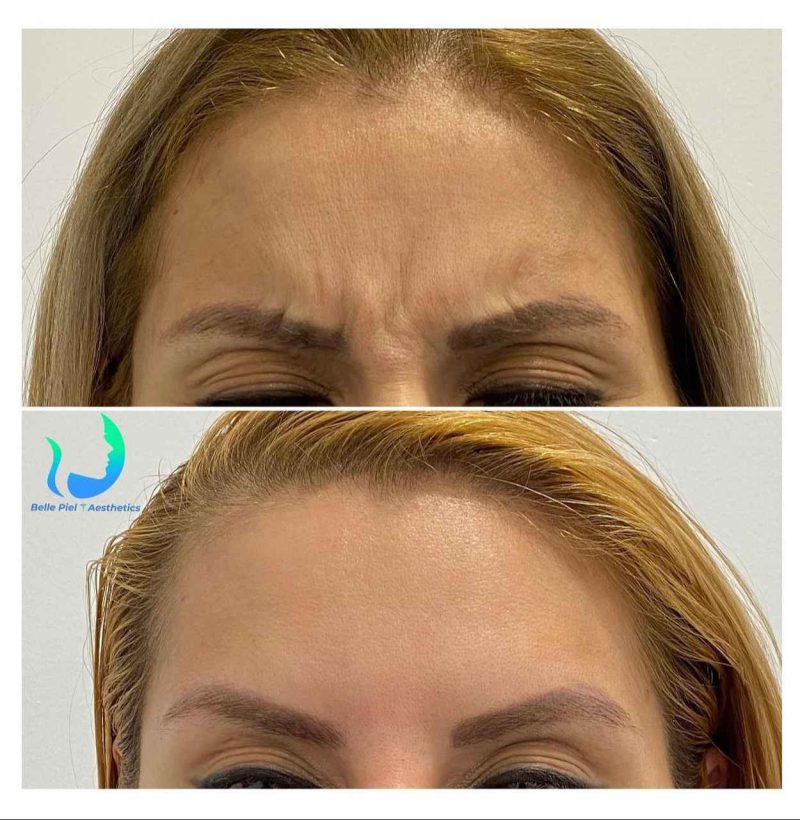 Neurotoxin Before After Treatment | Belle Piel Aesthetics | Farmingville, NY