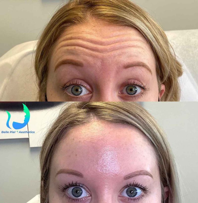 Neurotoxin Before After Treatment | Belle Piel Aesthetics | Farmingville, NY