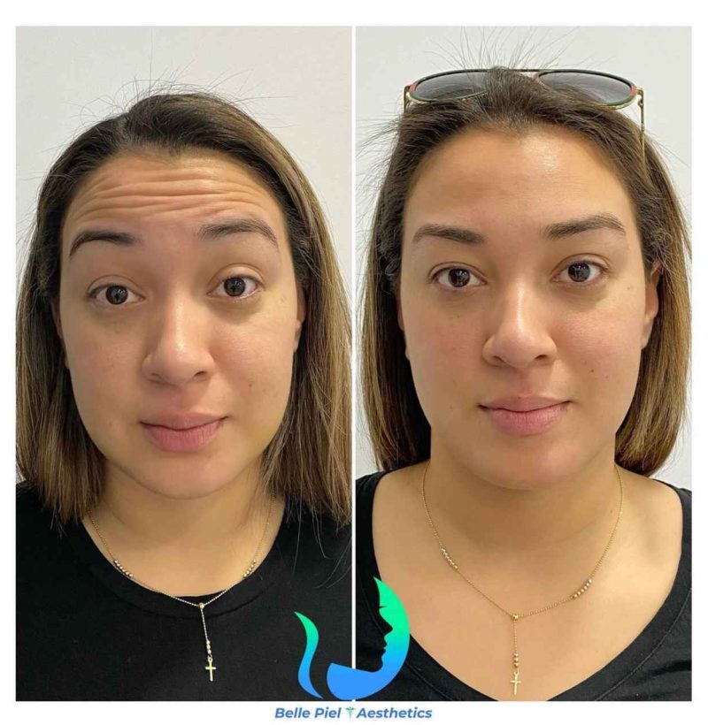 Neurotoxin Before After Treatment | Belle Piel Aesthetics | Farmingville, NY